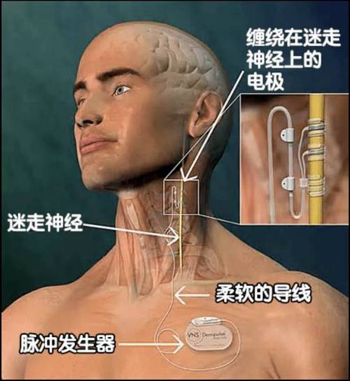 迷走神经电刺激术无需开颅，治疗难治性癫痫