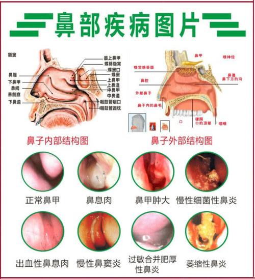鼻炎跟鼻咽癌的区别在哪里。